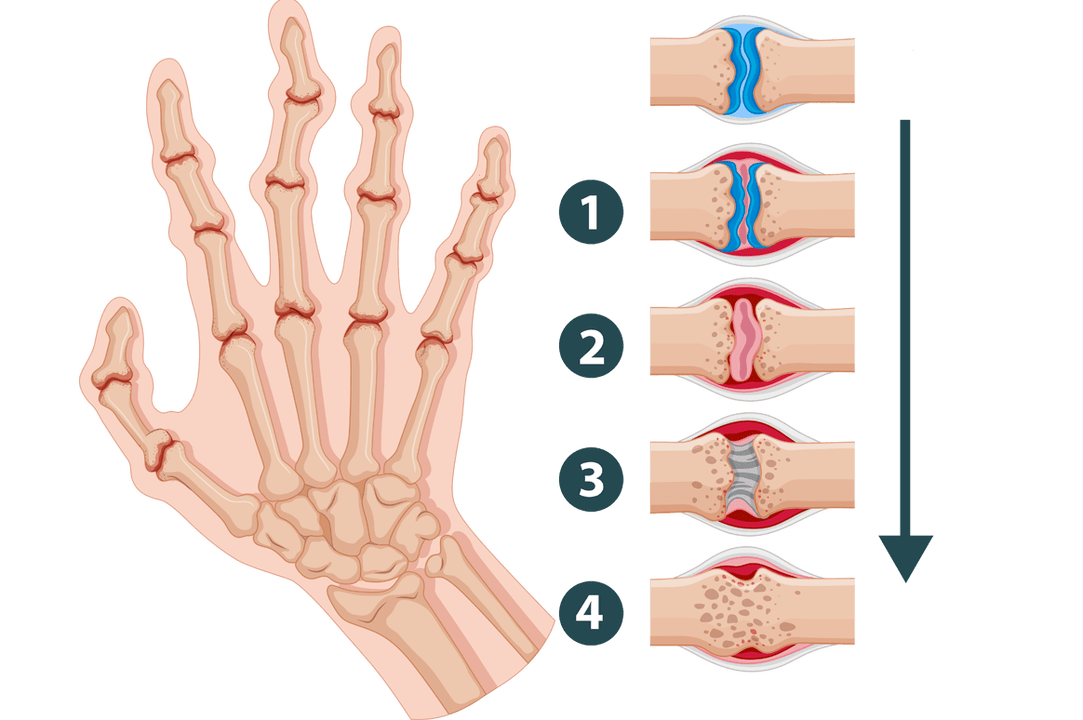 Faze razvoja artritisa - vnetne poškodbe sklepov