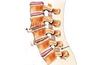 spondilarthroza kot vzroki bolečine v hrbtu