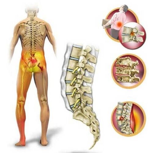 Osteohondroza ledvene hrbtenice, ki povzroča bolečine v spodnjem delu hrbta