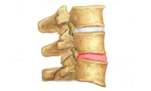 Protruzija medvretenčne ploščice hrbtenice - znak osteohondroze