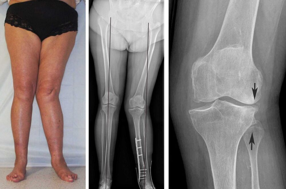 Klinična slika osteoartritisa kolena